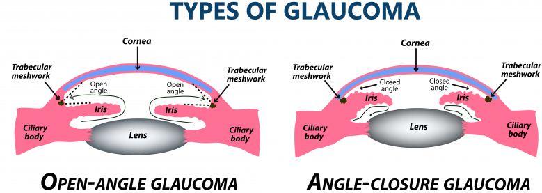 jenis-jenis glaukoma