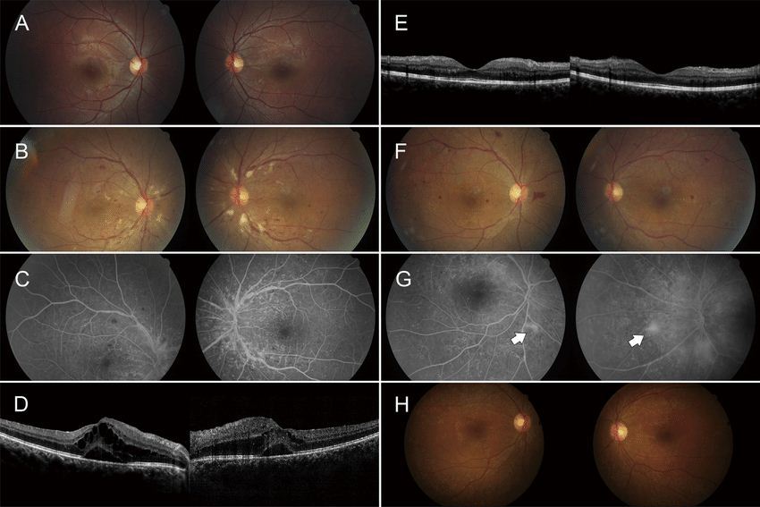 pemeriksaan mata untuk retinopati diabetikum