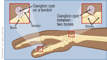 kista ganglion