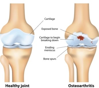sendi osteoarthritis